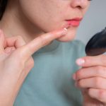 Is It a Cold Sore or a Pimple? How To Tell the Difference