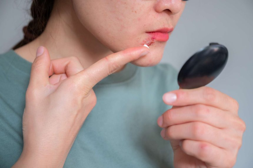 Is It a Cold Sore or a Pimple? How To Tell the Difference