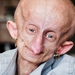 TikTok star Beandri Booysen dies at 19 from rare disease that causes rapid aging