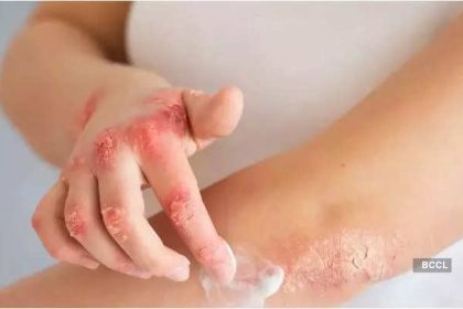 Winter skin woes: 6 things to do for preventing psoriasis flare-ups in cold weather