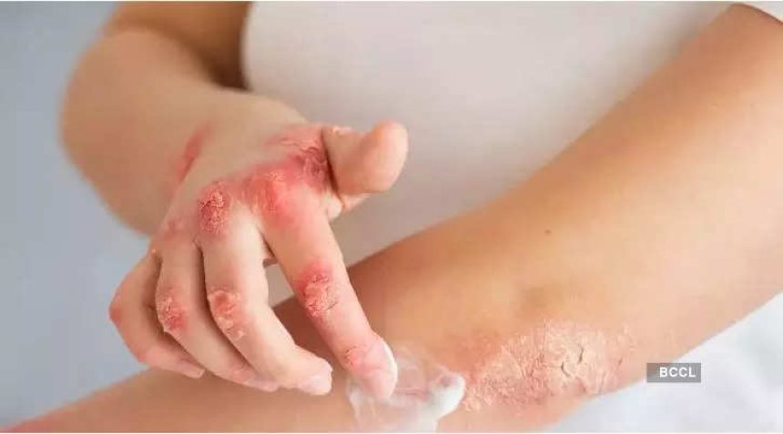 Winter skin woes: 6 things to do for preventing psoriasis flare-ups in cold weather