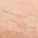 13 Ways To Prevent Spider Veins and Maintain Healthy Skin