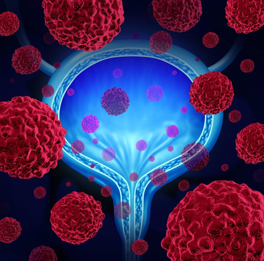 An illustration of microscopic cancerous malignant cells spreading in the bladder to represent bladder cancer