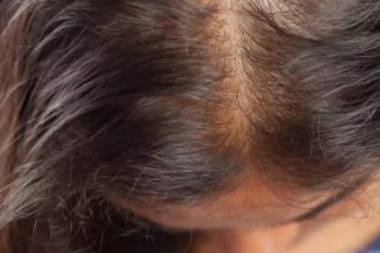 How to regrow hair on bald spot really fast