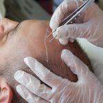 Other popular medical tourism procedures include hair transplants.