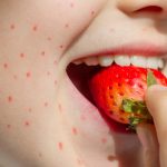 Red, itchy, raised spots can be a sign of an allergic reaction (Alamy/PA)